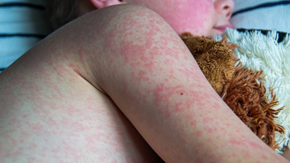 Healthcare workers treat patients hospitalized for severe measles complications during a recent Texas outbreak.