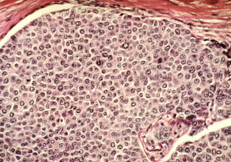 Medical ultrasound device targeting tumor tissue