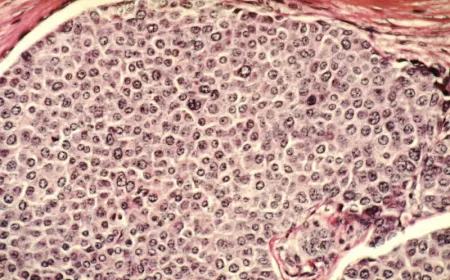 Medical ultrasound device targeting tumor tissue