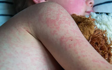 Healthcare workers treat patients hospitalized for severe measles complications during a recent Texas outbreak.